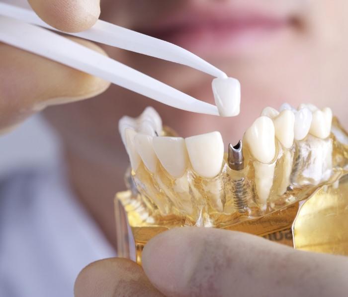 Dentist placing crown onto model of dental implant