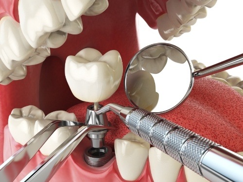 Illustrated dental implant with crown being placed in lower jaw