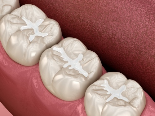 Close up of illustrated row of teeth with tooth colored fillings