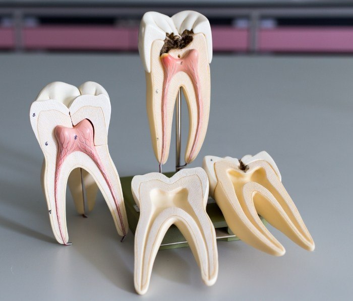 Models of damaged teeth