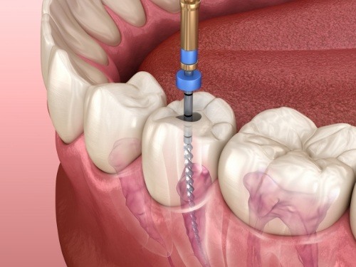 Illustrated dental instrument cleaning the inside of a tooth